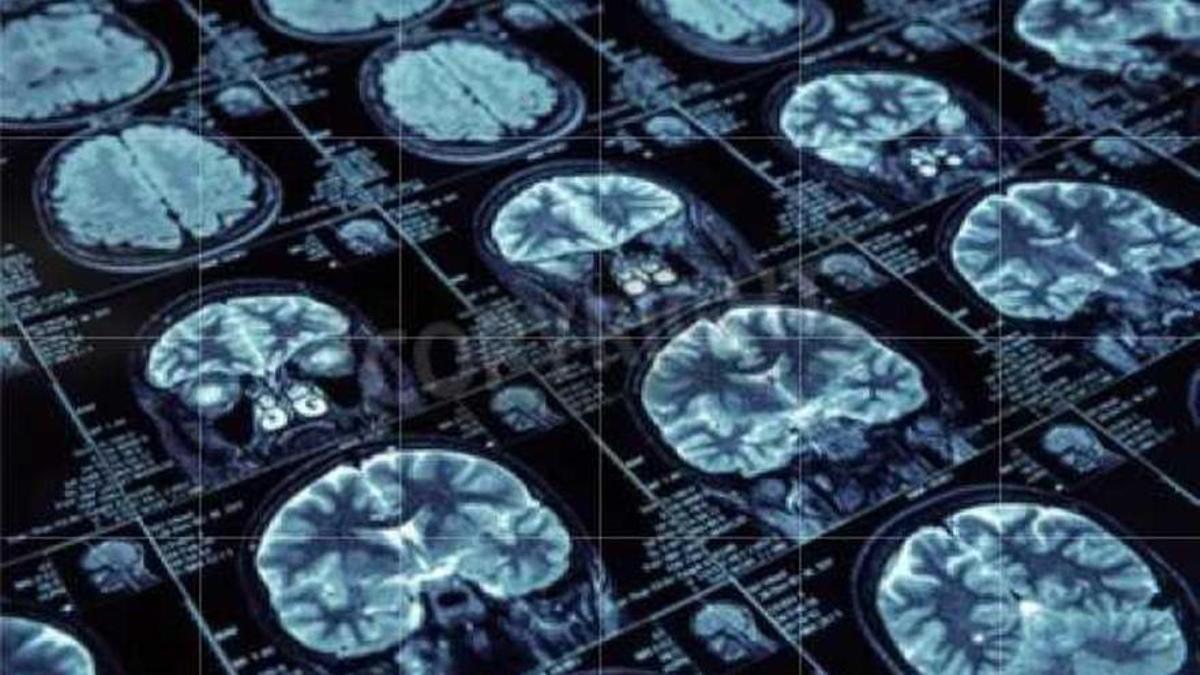Imágenes de escáner de un cerebro.