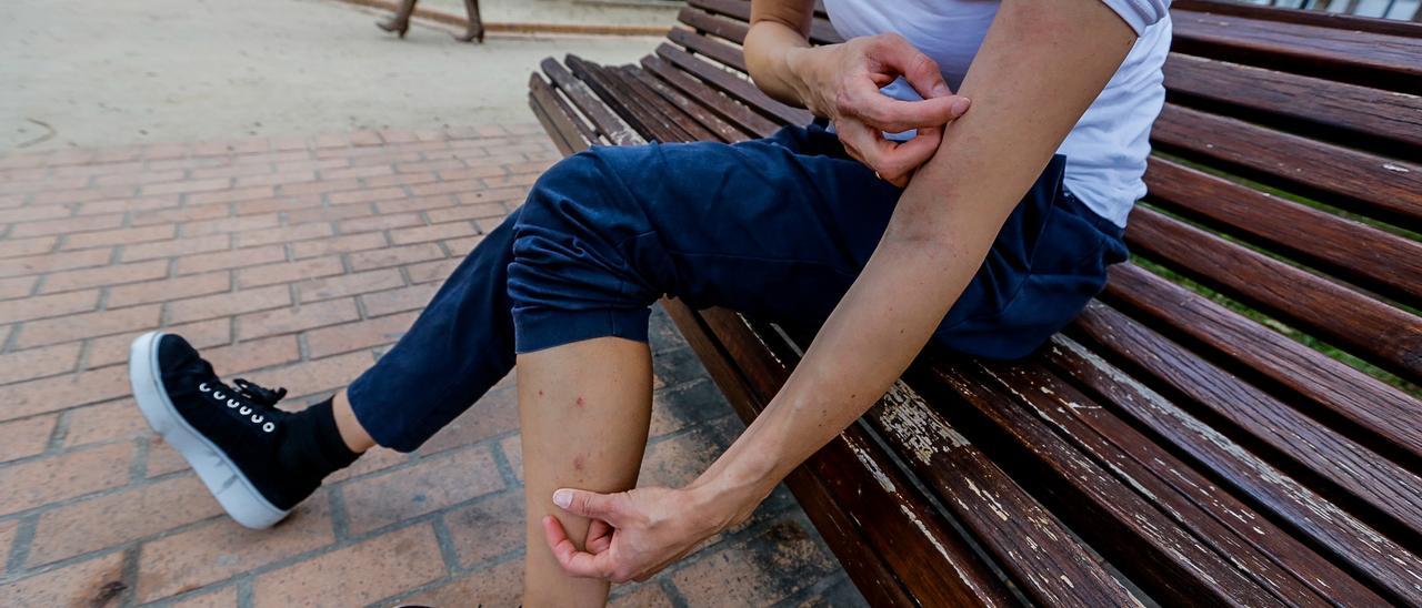 La sarna provoca intensos picores y lesiones en quien contrae el parásito