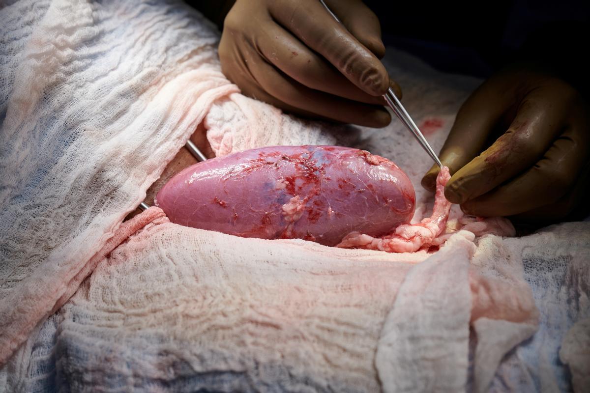 El equipo quirúrgico examina el riñón de cerdo