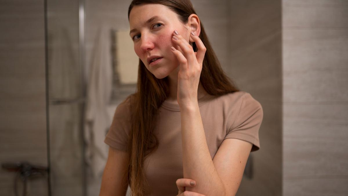 La rosácea es considerada una enfermedad inflamatoria crónica de la piel, prima del acné.