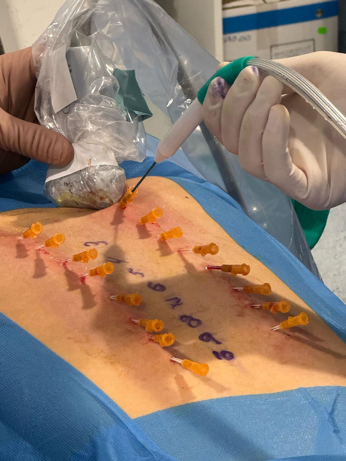 Intervencion con la técnica de Crioanalgesia en Quirónsalud Málaga