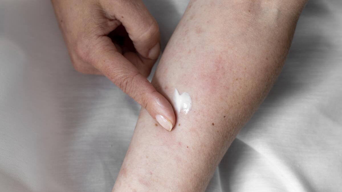 Alivia la dermatitis atópica con estas cremas y geles que realmente funcionan