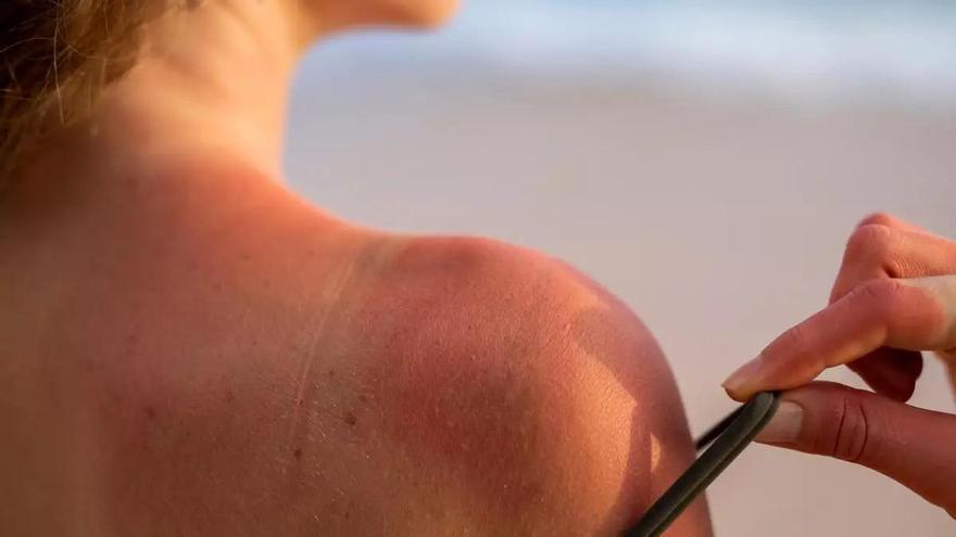 Remeis casolans per a cremades lleus pel sol: quins funcionen i quins has d'evitar?
