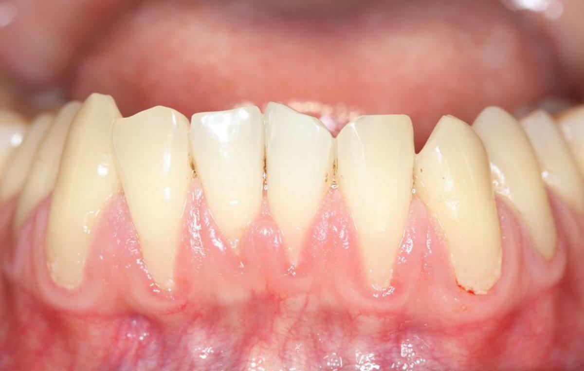 Boca de un paciente con recesión gingival.