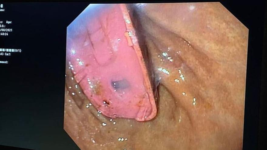Una imagen del teléfono móvil dentro del estómago del paciente.