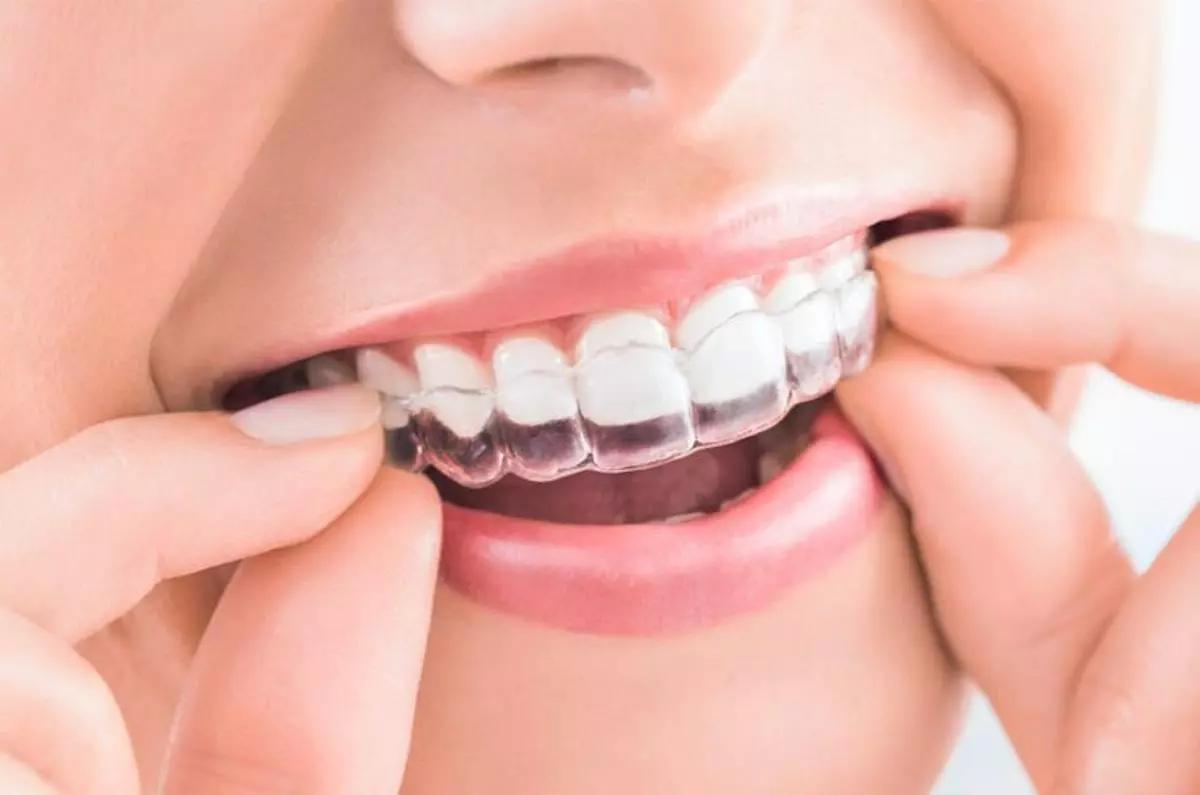 El tratamiento de ortodoncia invisible Invisaling consigue excelentes resultados sin las molestias de los traicionales brackets.