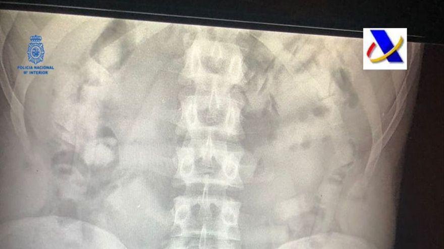 Imagen de rayos X que muestra la droga en el organismo del acusado