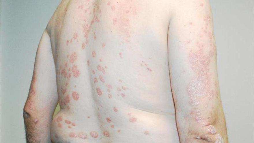 Dermatólogos de Aragón se reúnen online para avanzar en el abordaje de la psoriasis