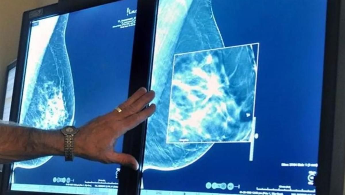 Más allá de las mastectomías: estos son los otros casos en los que se realizan reconstrucciones mamarias