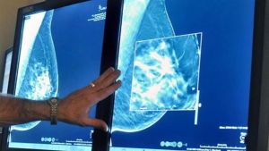 Más allá de las mastectomías: estos son los otros casos en los que se realizan reconstrucciones mamarias
