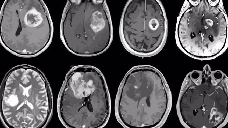 Científicos españoles avanzan en la lucha contra el glioblastoma, el cáncer cerebral más agresivo