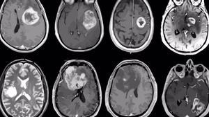 Glioblastoma, tumor cerebral agresivo mapeado en detalle genético y molecular.