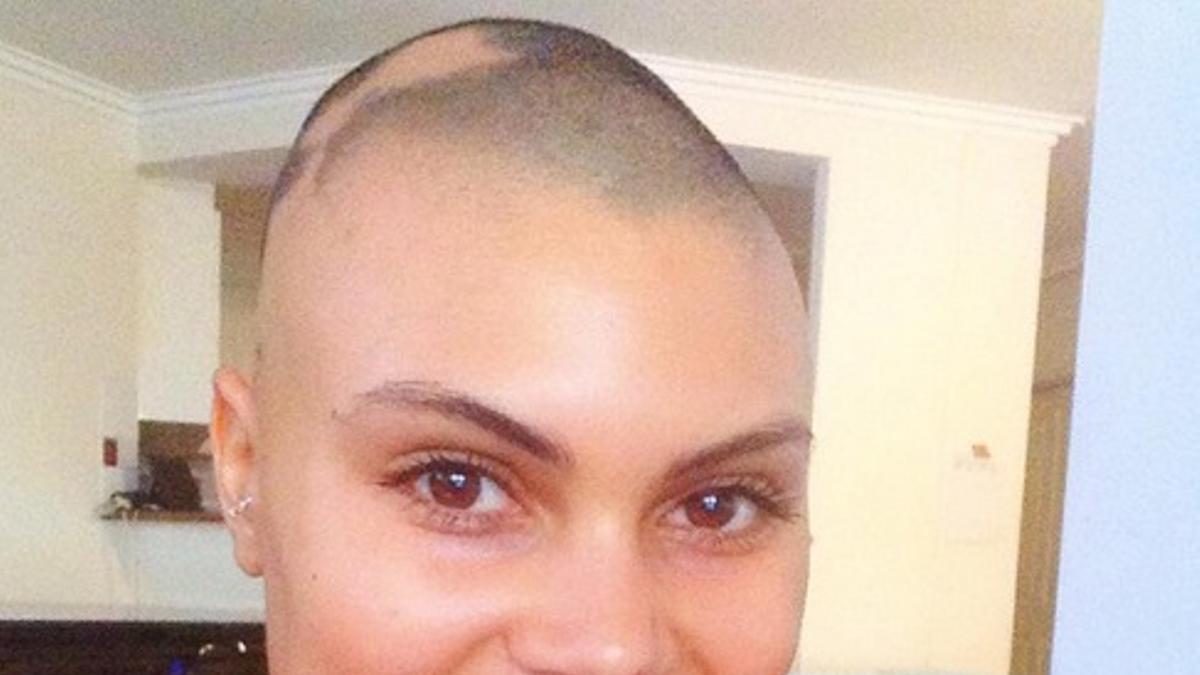 Mujer con alopecia 3