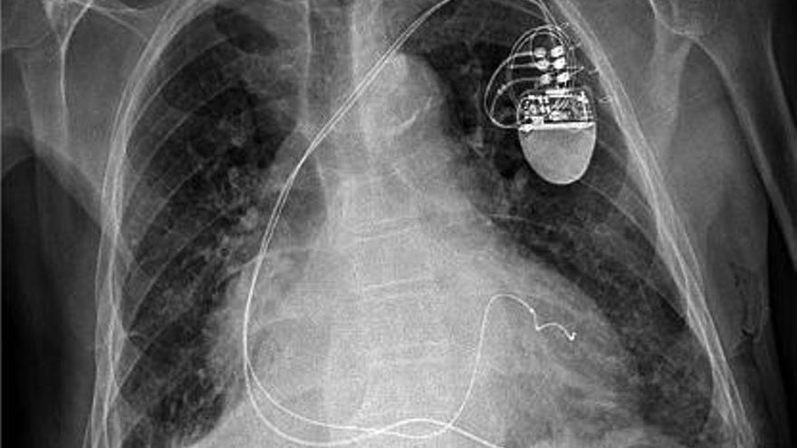 L&#039;aparell connecta tres cables al cor: un a l&#039;aurícula dreta i els altres dos, un a cada ventricle.