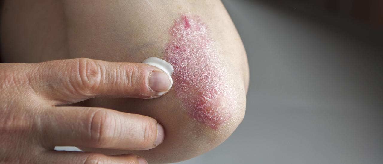 La psoriasis afecta al 2,3% de la población española.