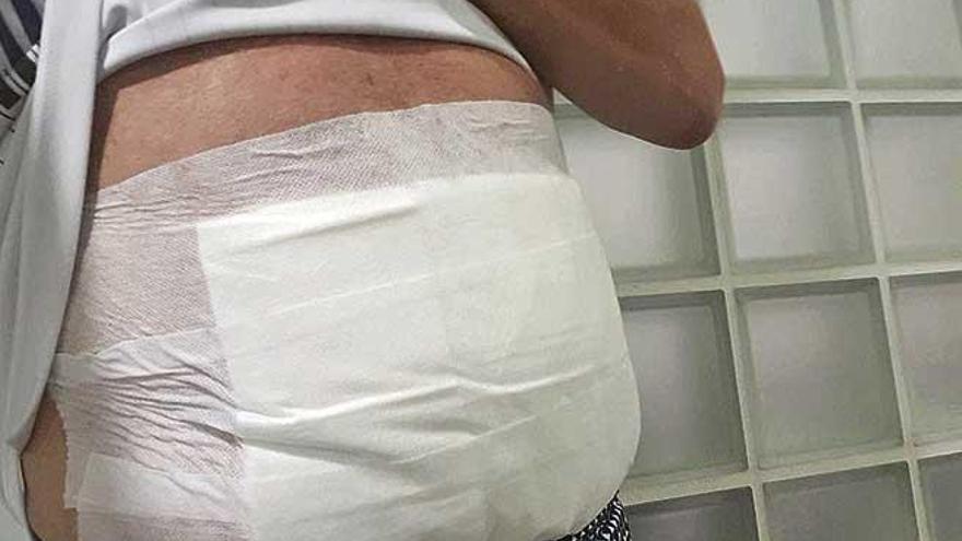 El denunciante sufrió quemaduras en el abdomen a raíz de la agresión.