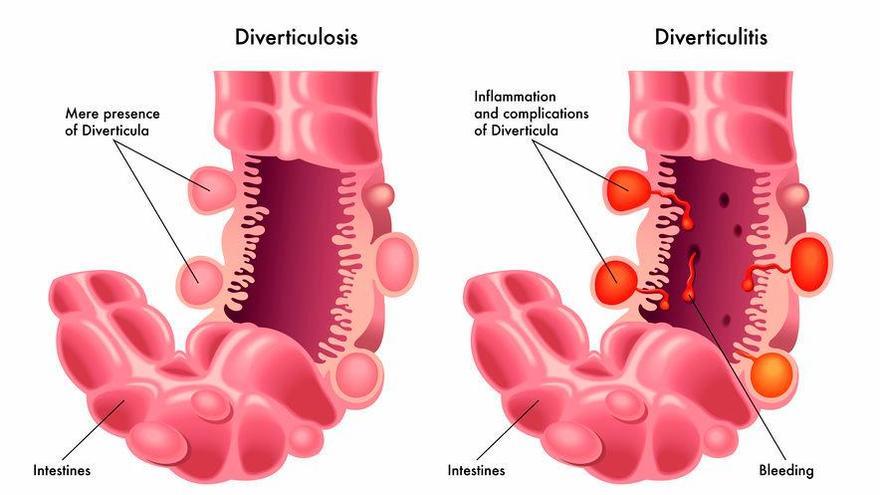 Diverticulitis / Sociedad Española de Medicina Interna (SEMI)