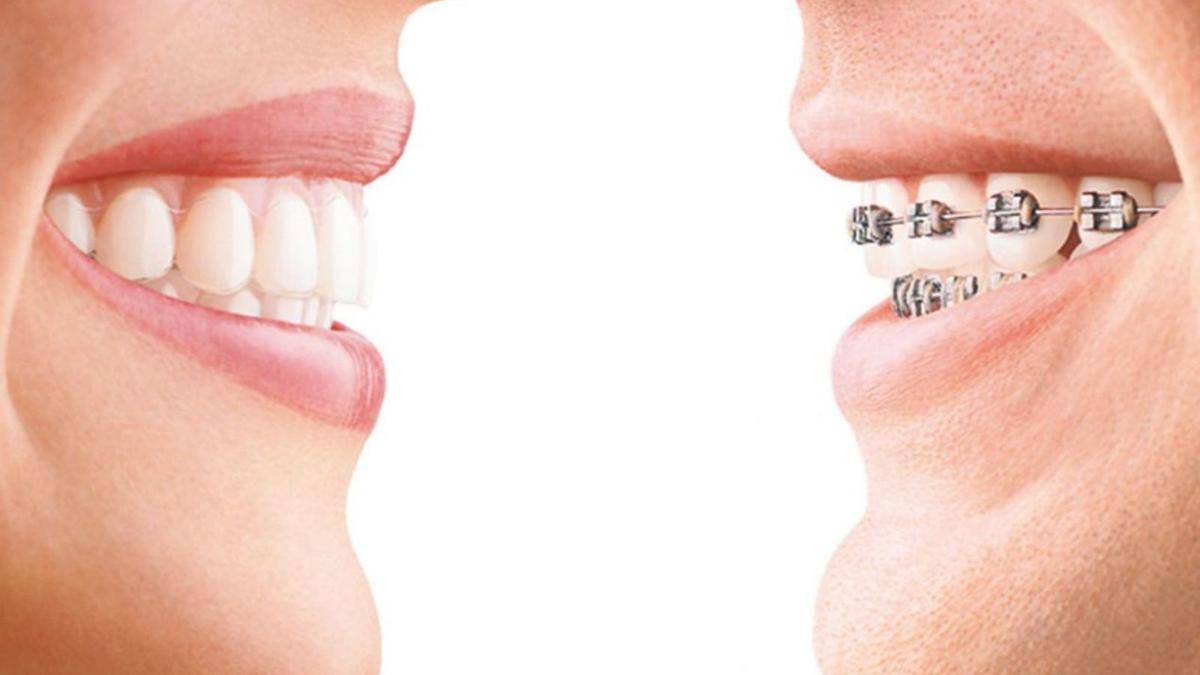 Der neueste Schrei sind unsichtbare Zahnspangen – „los brackets invisibles“.  | FOTO: INVISALING