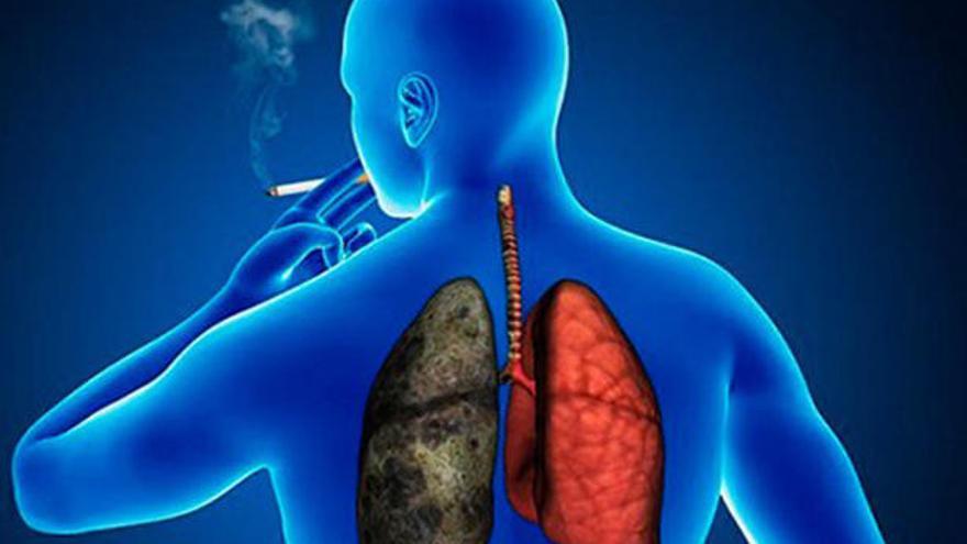 Cerca de 19.000 murcianos sufren Enfermedad Pulmonar Obstructiva Crónica