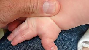 Síndrome de Rubinstein Taybi, la enfermedad de los dedos gordos / ELSEVIER