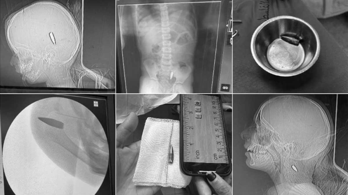 Balas y radiografías de los disparos de bala israelíes en los cuerpos de niños en Gaza