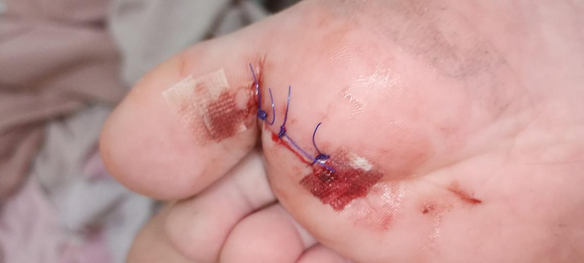 Corte ya suturado de Alondra en la planta de su pie derecho.