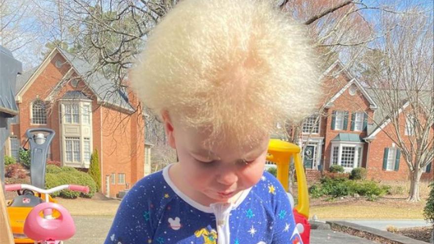 Els cabells d’un nen d’Instagram donen a conèixer la ‘síndrome dels cabells que no es poden pentinar’