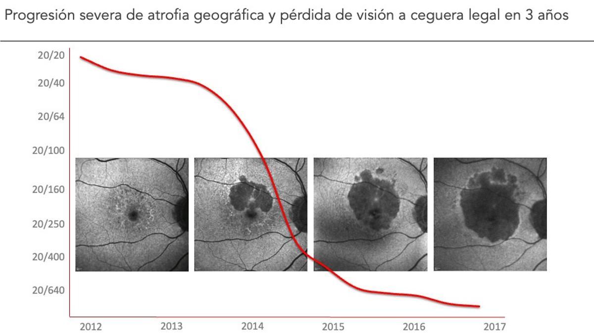 La mácula de una paciente de 78 años. En muy pocos años desarrolló zonas de atrofia que crecieron y se expandieron en muy pocos tiempo (las zonas más oscuras). Pasó de una visión normal (20/20) a ceguera legal (20/200) en tres años, y siguió perdiendo visión posteriormente. 