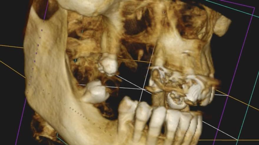 Solución en implantes dentales para pacientes con poco hueso en MAEX Cuevas Queipo