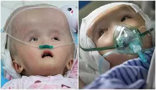 Trasplantan un cráneo impreso en 3D a una niña con hidrocefalia