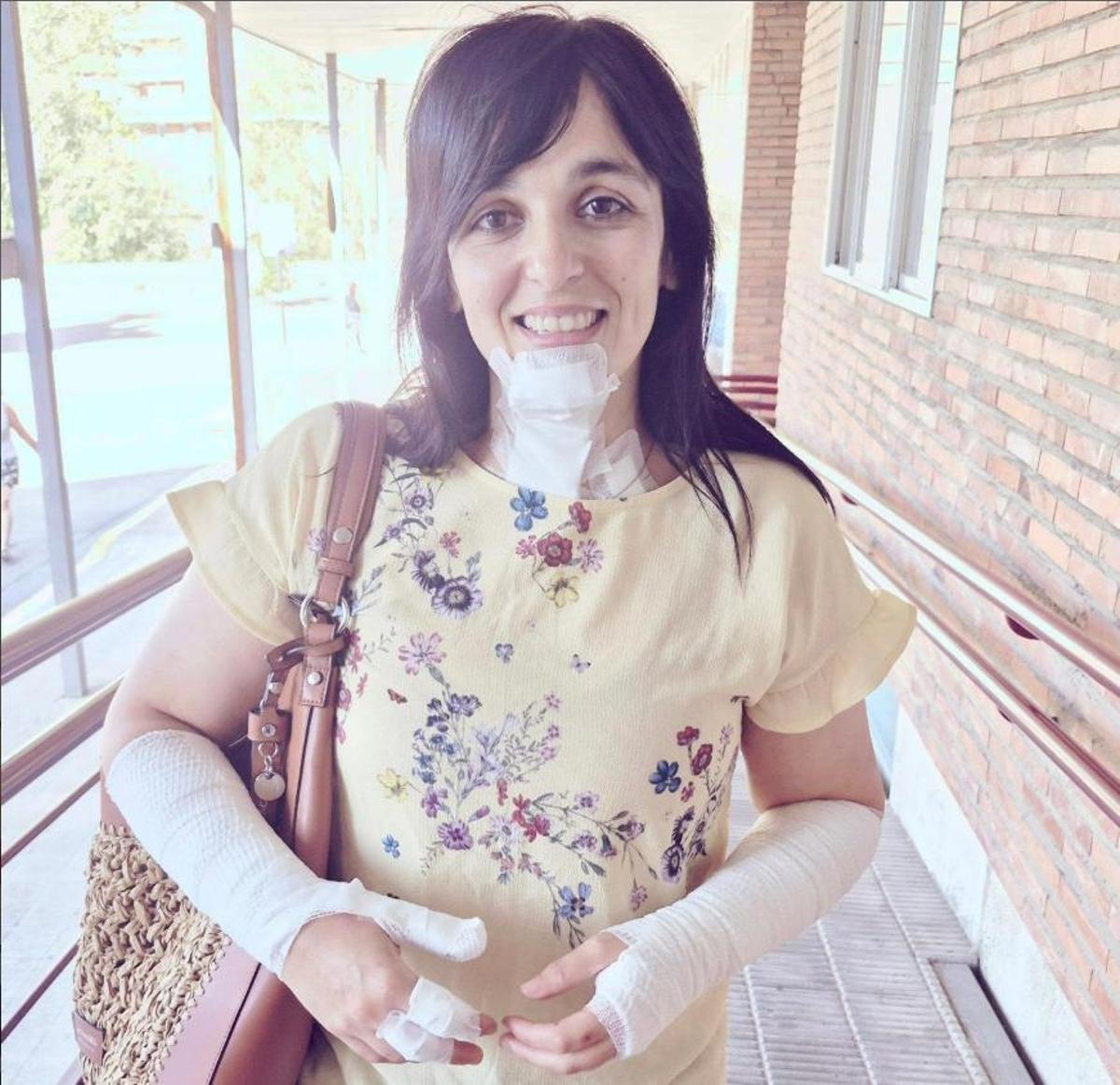 La alcaldesa de Ripoll, Sílvia Orriols, con quemaduras en la cara y los brazos tras un accidente doméstico