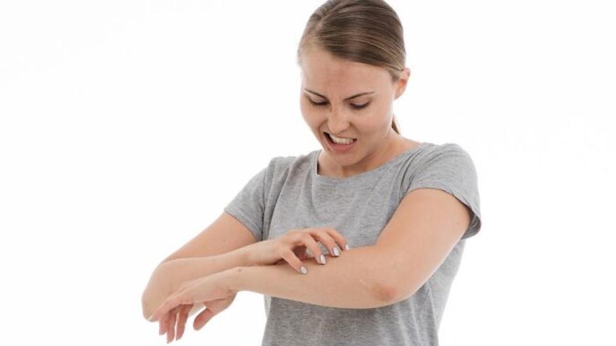 Qué es la dermatitis atópica y cómo evitar el desesperante picor