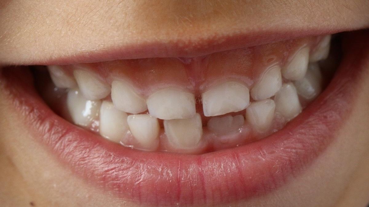 Las caries en los dientes de leche pueden afectar a los definitivos