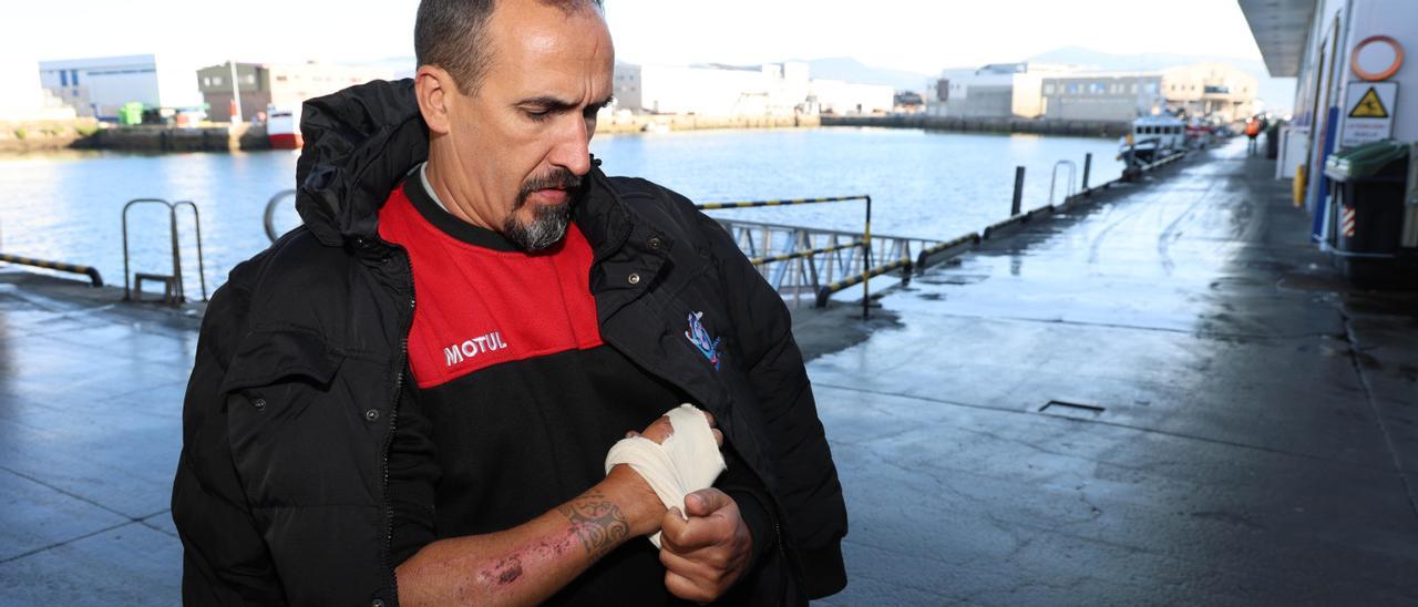 Óscar Parada muestra los daños en su brazo derecho a causa del impacto de la piedra.