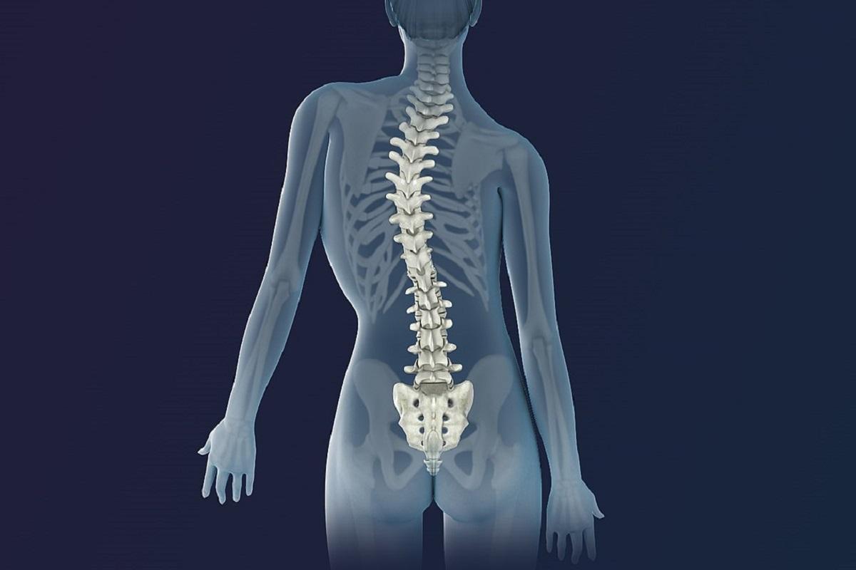 En España se calcula que la escoliosis idiopática puede afectar a entre 70.000 y 105.000 adolescentes.