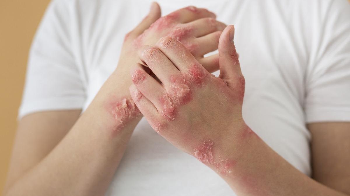 El impacto emocional de la psoriasis, la enfermedad que afecta a un millón de españoles.