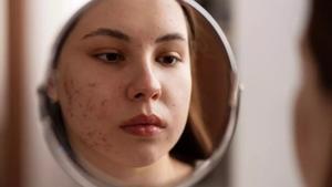 L’estrès, les dietes i la cosmètica disparen l’acne en dones adultes