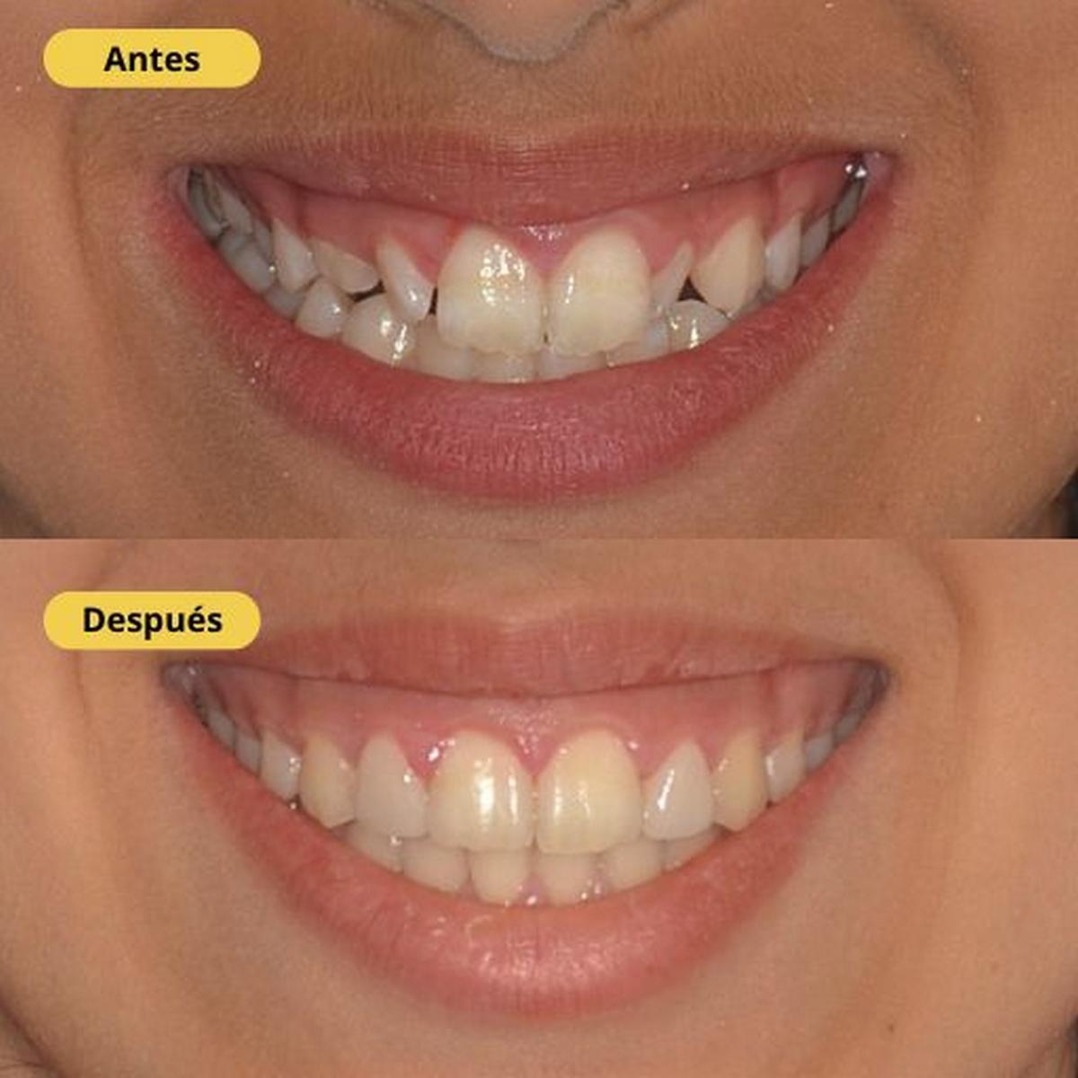 Antes y después de un tratamiento de estética dental con carillas de porcelana en IOC Clínica Dental