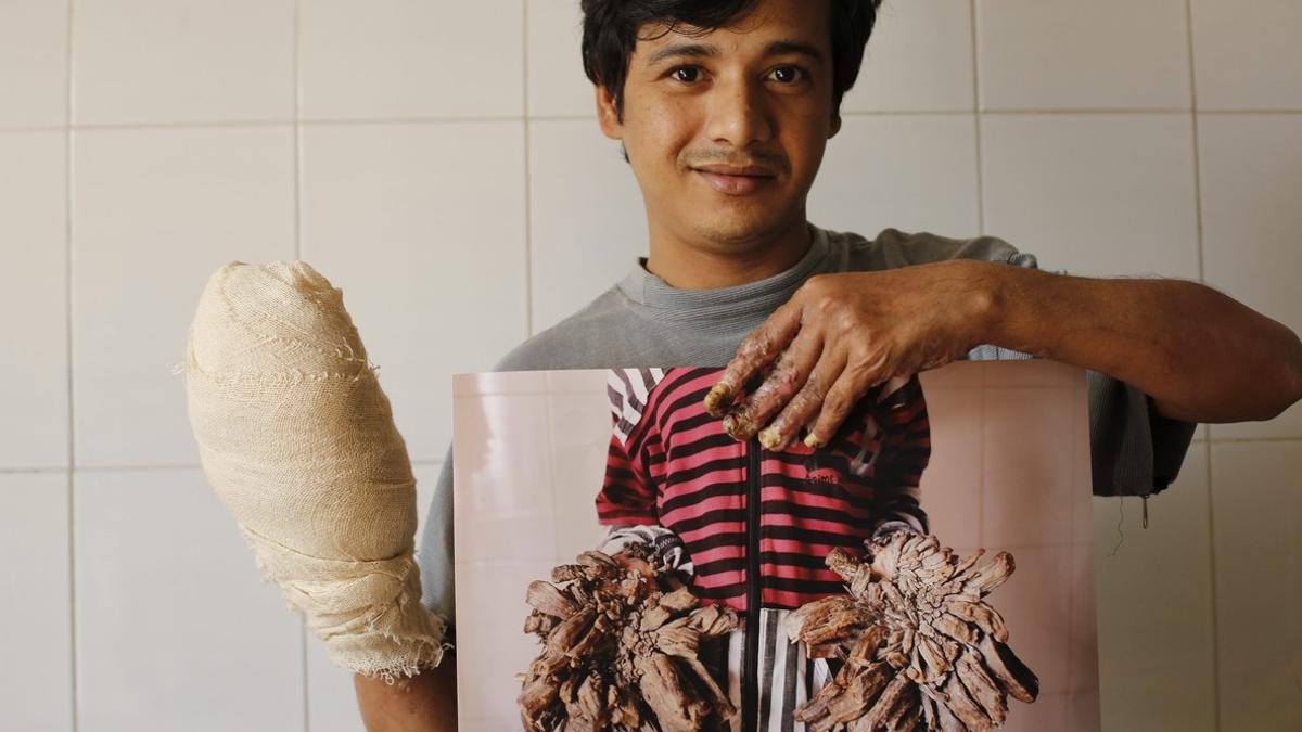 Abul Bajandar muestra una fotografía de cómo estaban sus manos antes de someterse a 16 operaciones en el Dacca Medical College en Bangladesh.