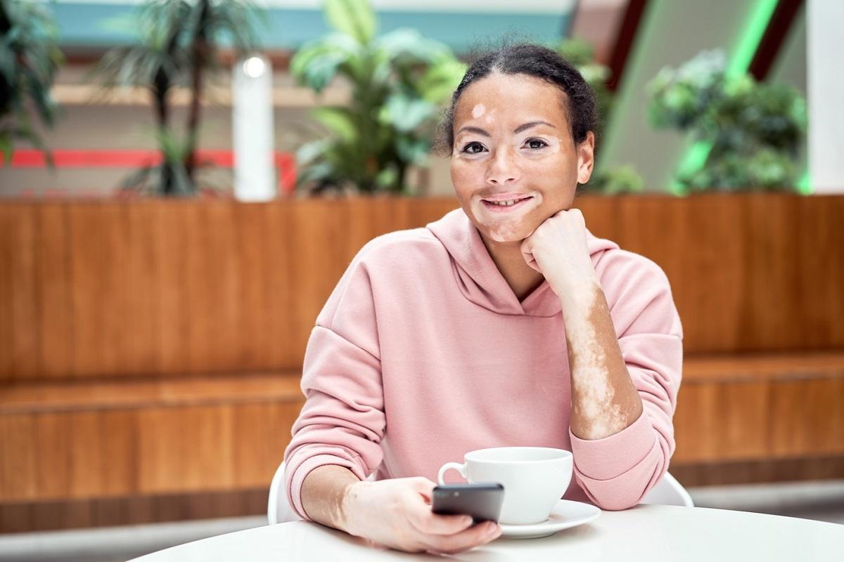 Aprobado un nuevo tratamiento para el vitíligo.