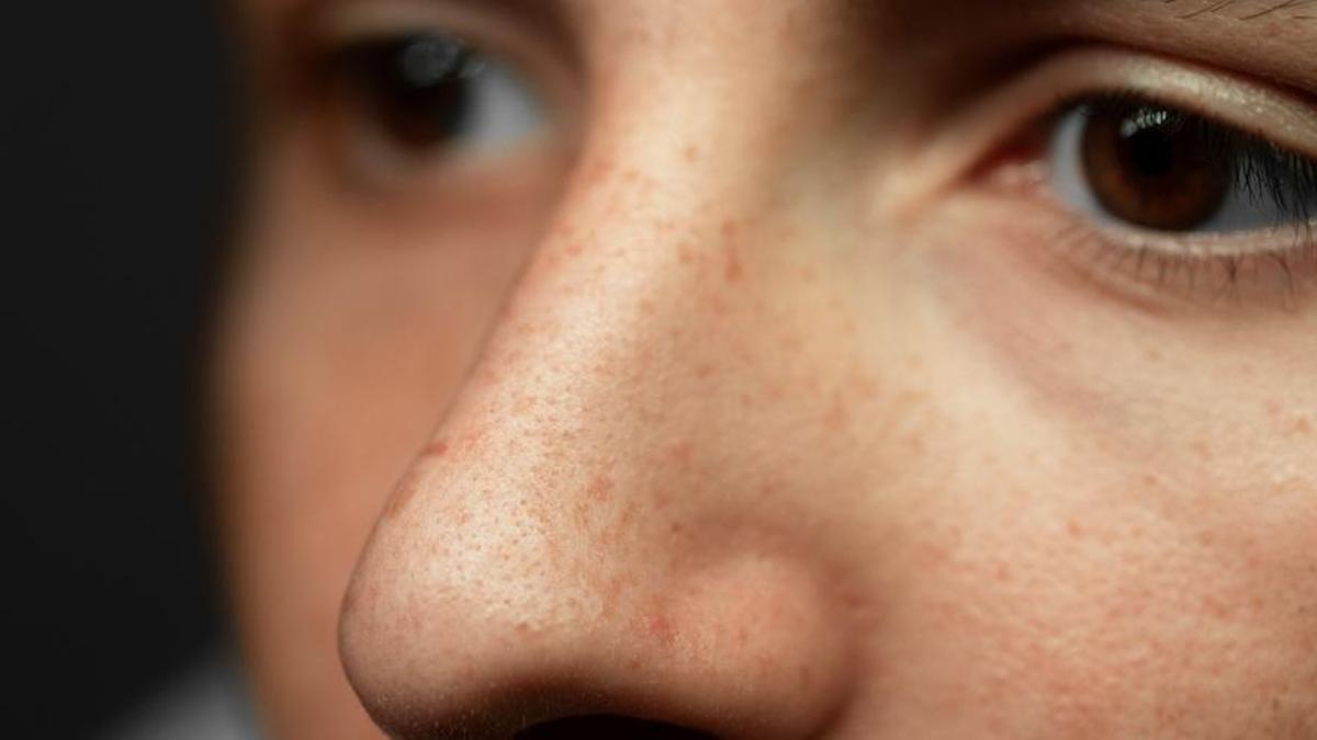 De los tratamientos antimanchas a los bioestimuladores de colágeno: estos son los 5 procedimientos estéticos más demandados