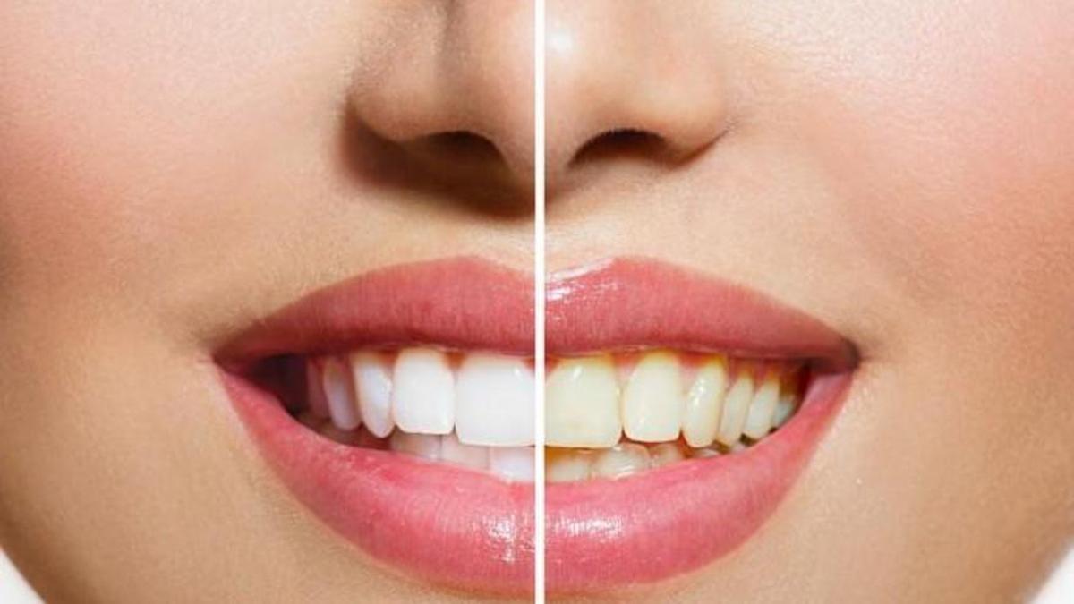 Per què s'engrogueixen les dents?