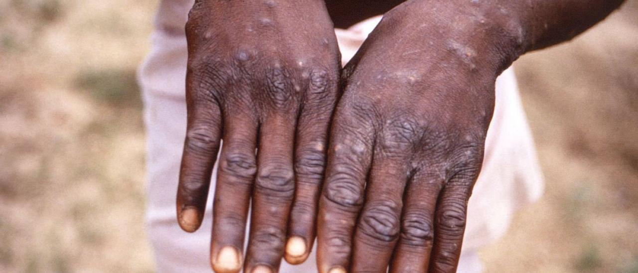 Las manos de un paciente afectado por la viruela del mono. | CDC
