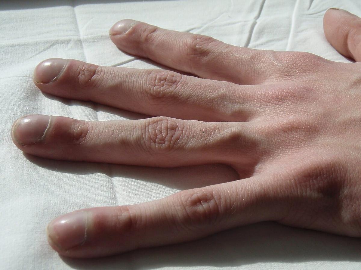protuberancias en los dedos como síntoma de la fibrosis quística
