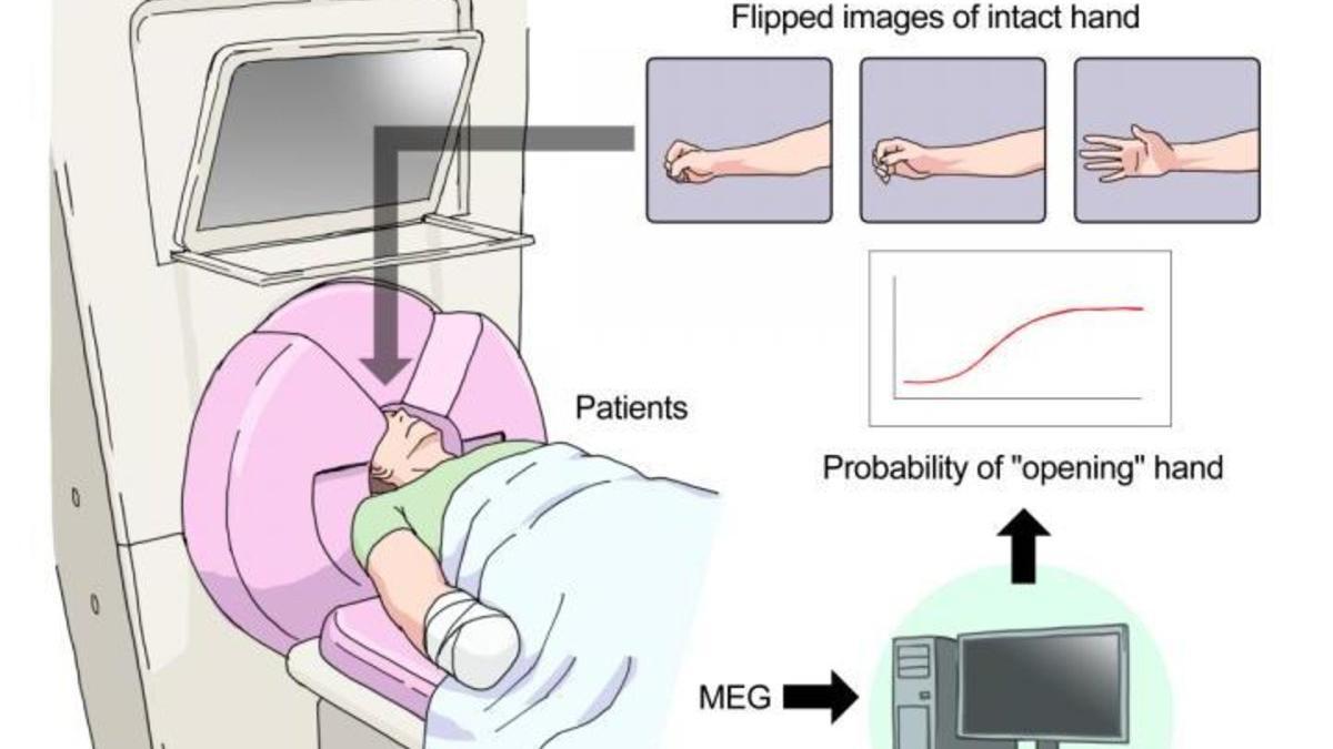 El cerebro se puede manipular para reducir el dolor del miembro fantasma