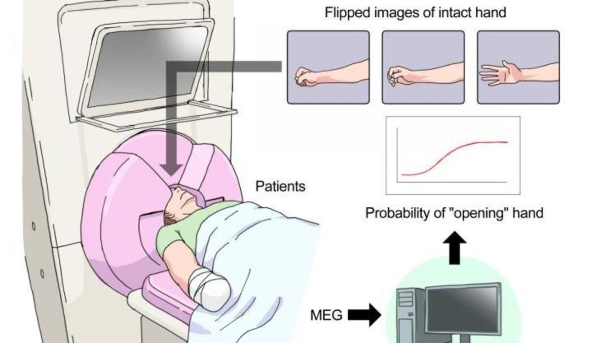 El cerebro se puede manipular para reducir el dolor del miembro fantasma