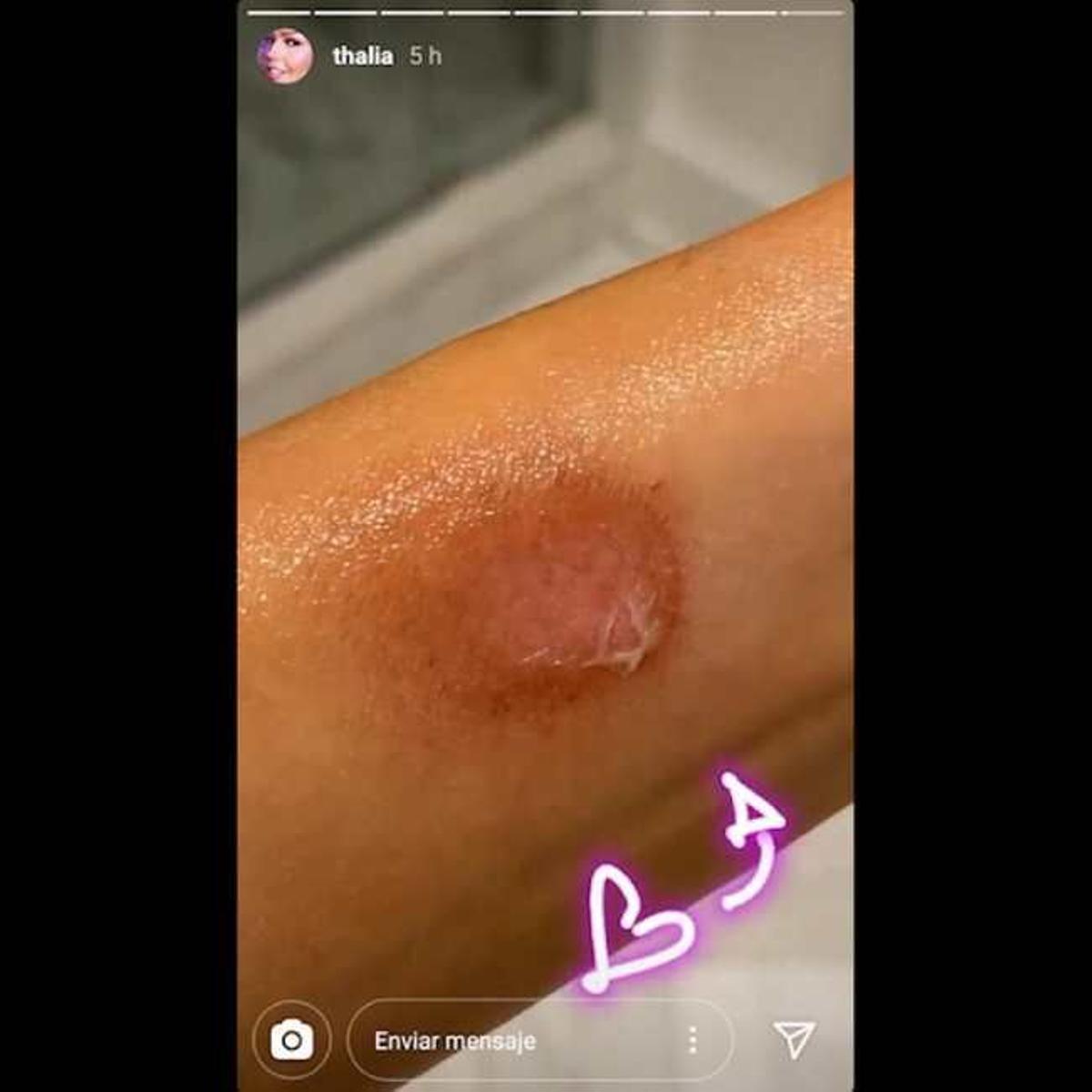 Thalía se quema el antebrazo con una bengala.