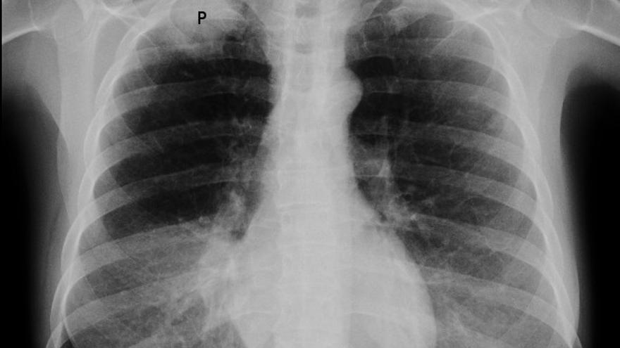 Radiografía de tórax que muestra un tumor de Pancoast en una mujer fumadora de 47 años