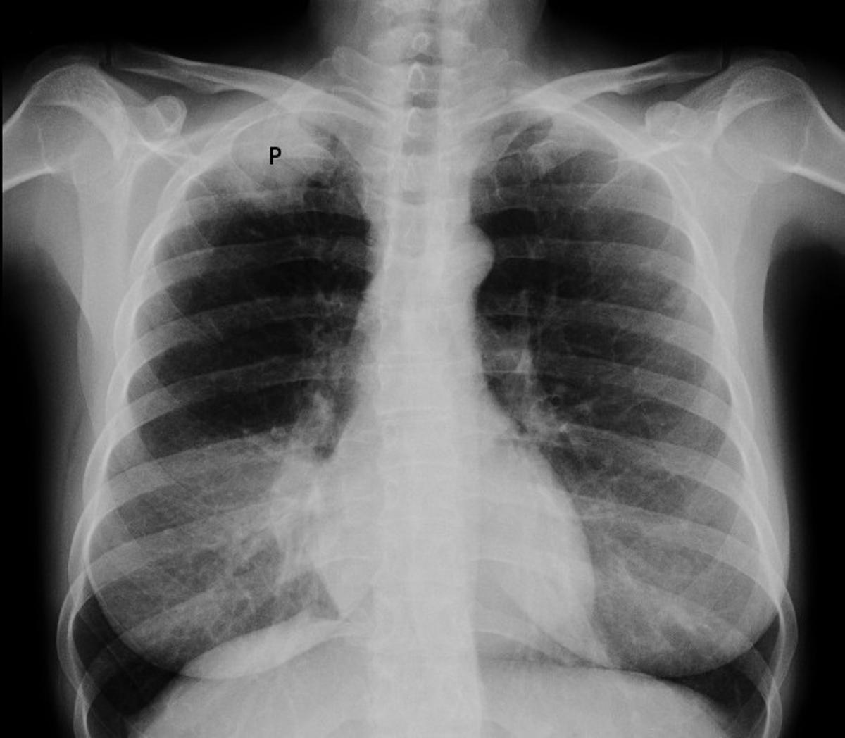 Radiografía de tórax que muestra un tumor de Pancoast en una mujer fumadora de 47 años
