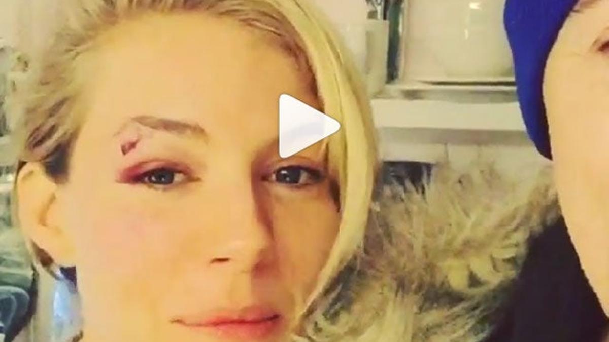 Sienna Miller se golpea en un ojo durante su actuación